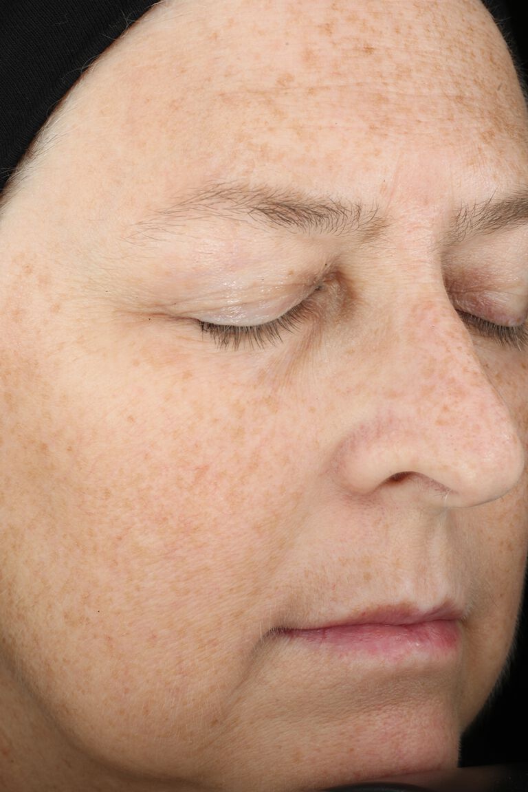 Day 1 of woman before application of Miracle Set.