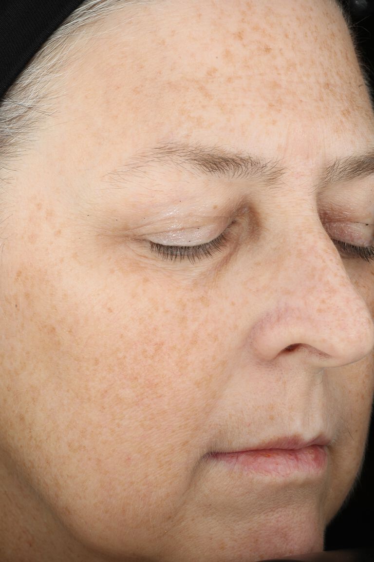 Week 12 of woman after application of Mircale Set.