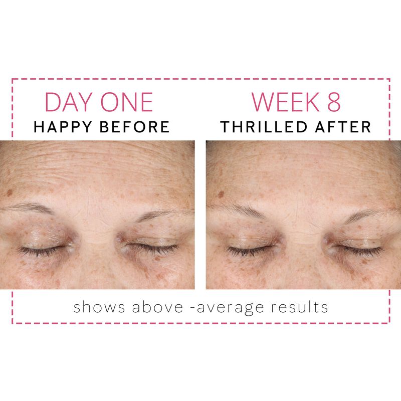 Before and after images showing above average improvement to the forehead area after eight weeks of using Dynamic Wrinkle Limiter