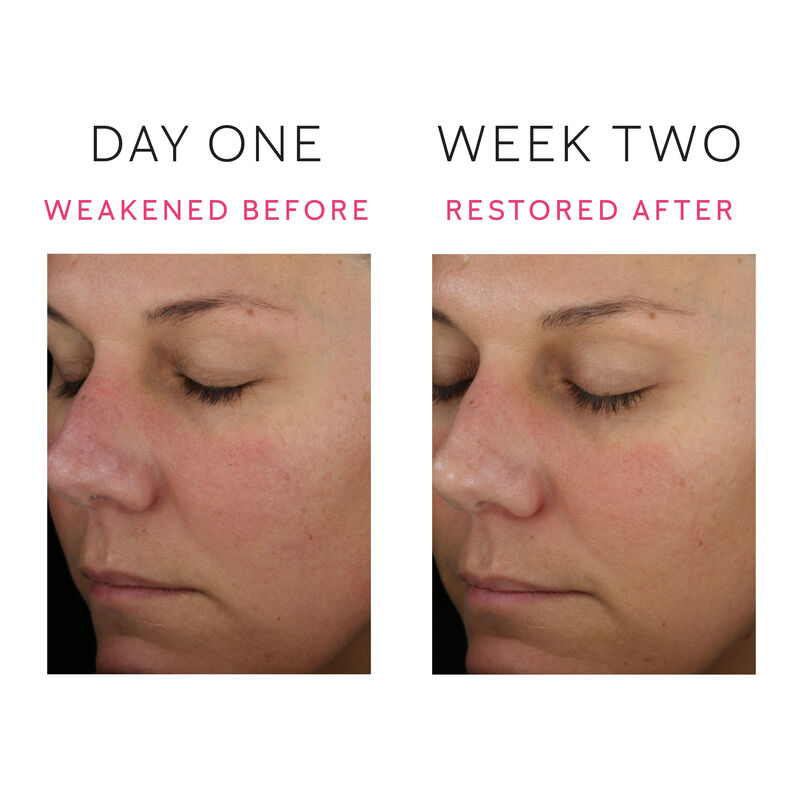 A set of before and after images showing a reduction in the appearance of skin redness from day one to week two&nbsp; image number null