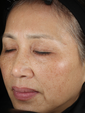 Week 12 of woman after application of Mircale Set.
